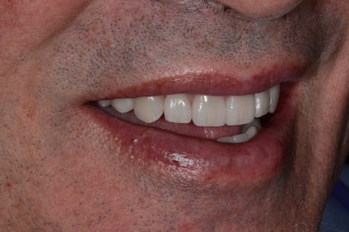 Porcelain Veneers Smile Gallery Arlington Heights Il