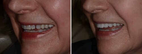 Results after dentistry at AH Smiles