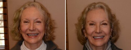 Results after dentistry at AH Smiles