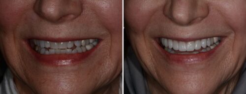 Results after dentistry at AH Smiles